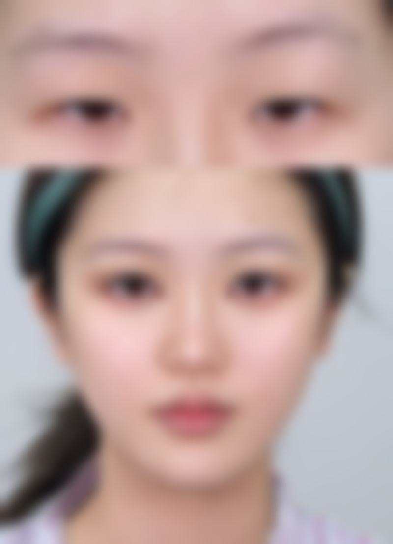 一、感觉下眼袋浮肿,常见原因有哪些