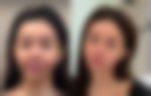 {怎样去除脸上的摔伤疤痕？这些小妙招助你淡化疤痕恢复光滑肌肤！ 