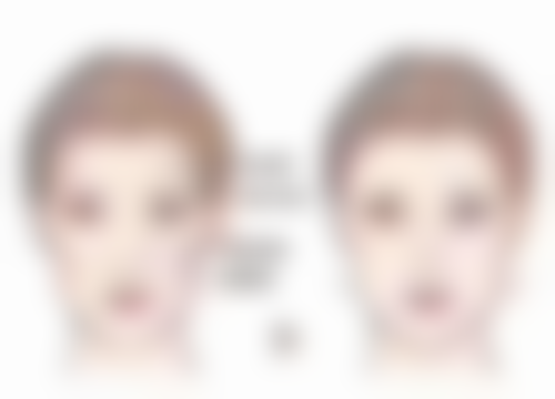 三、手臂抽脂的美学与安心建议