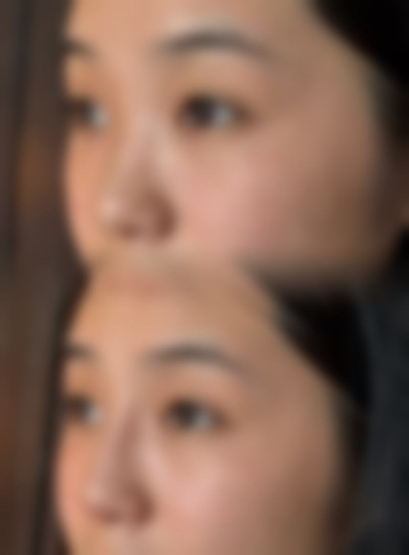 五、不适合手臂抽脂的人群