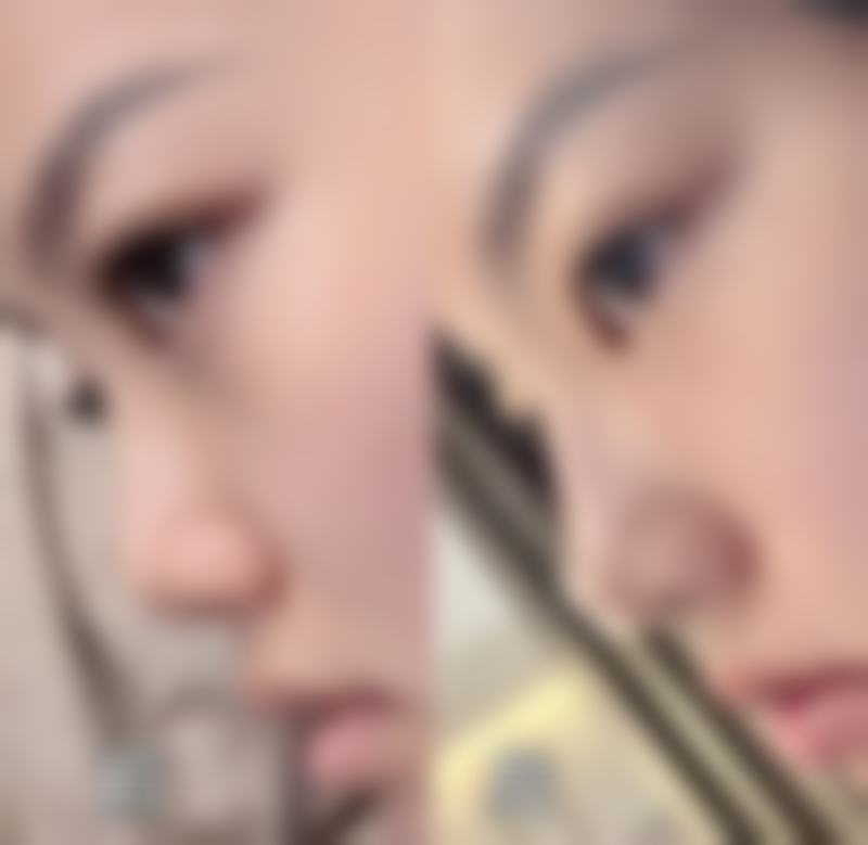 小孩子的疤痕好恢复吗？了解恢复因素及激光治疗适用性助孩子重拾光滑肌肤