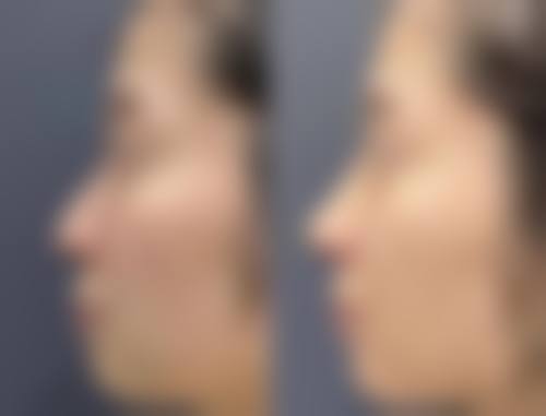 五、怎么样除疤痕疙瘩之药物治疗