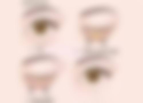 四、割完双眼皮的护理建议与注意事项