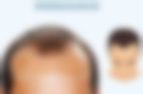 五、面部吸脂后输液的注意事项