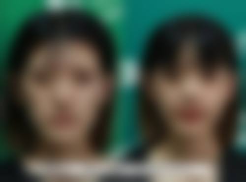 四、面部吸脂后输液与吃消炎药的对比