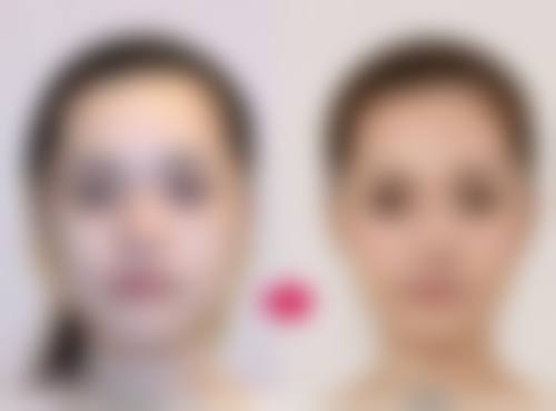 四、如何降低割眼袋手术的风险