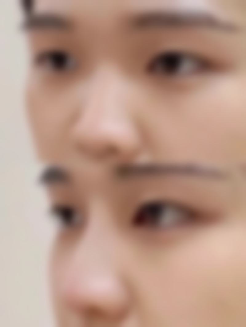 一、隆鼻耳软骨修复时间的整体情况