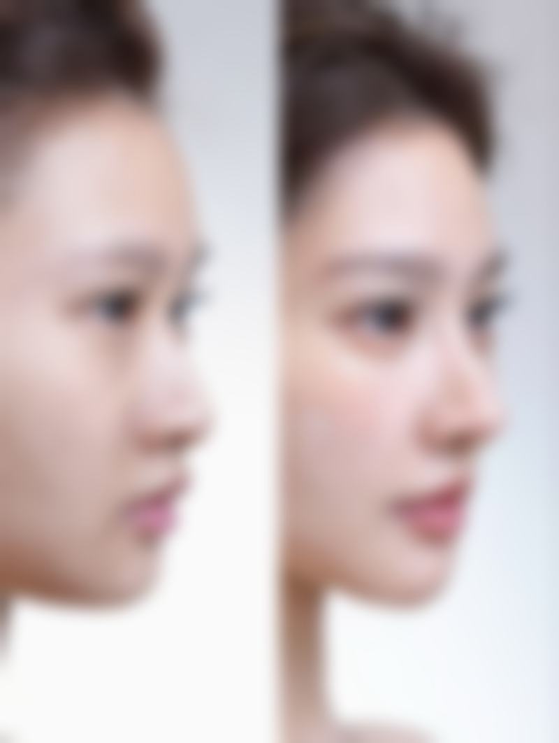 一、面部吸脂后肿胀是咋回事