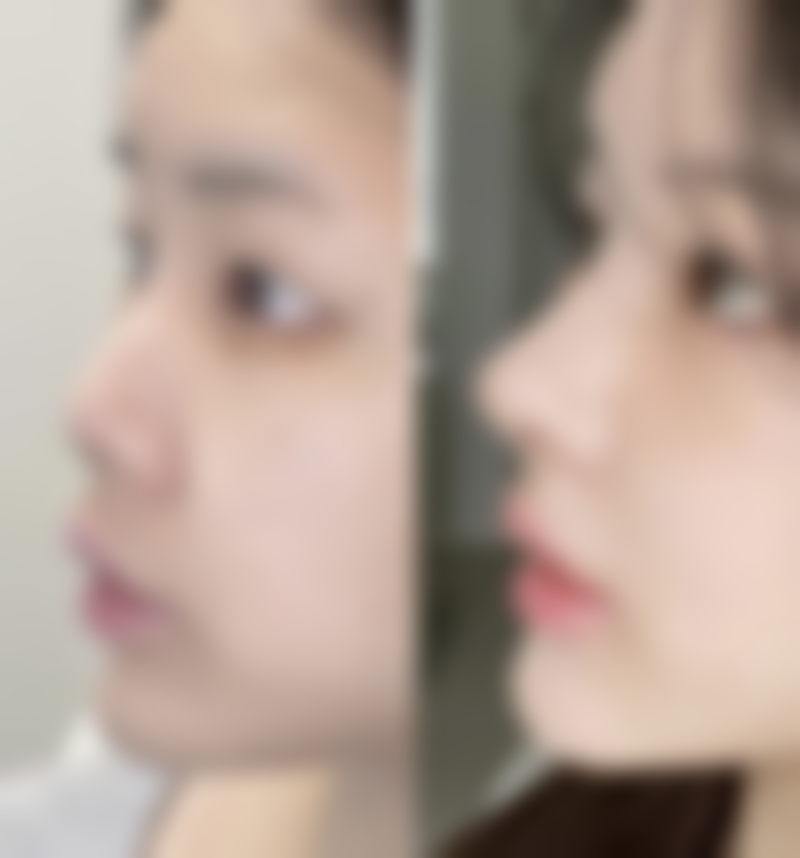 一、弄双眼皮后需避免的饮食类型