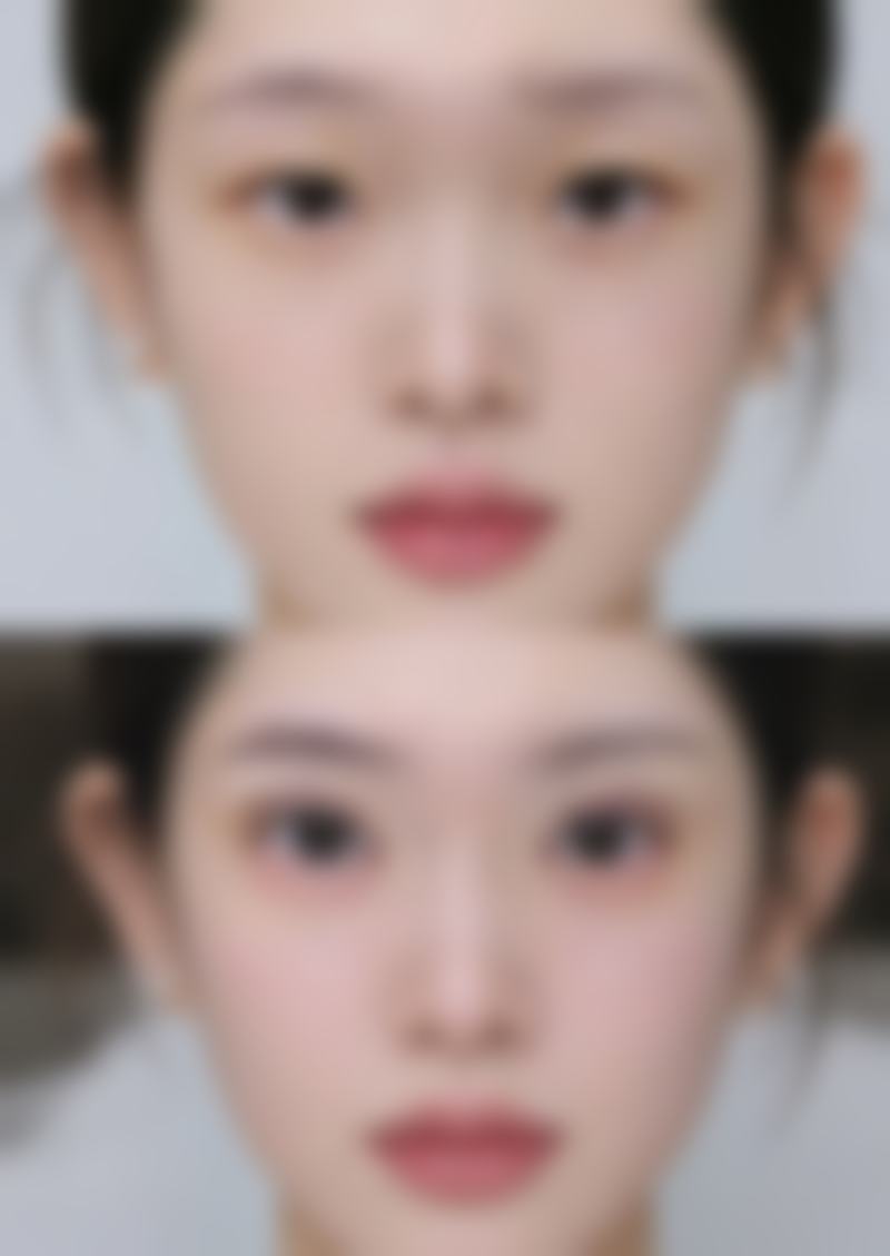 三、影响甲状腺疤痕淡化的因素