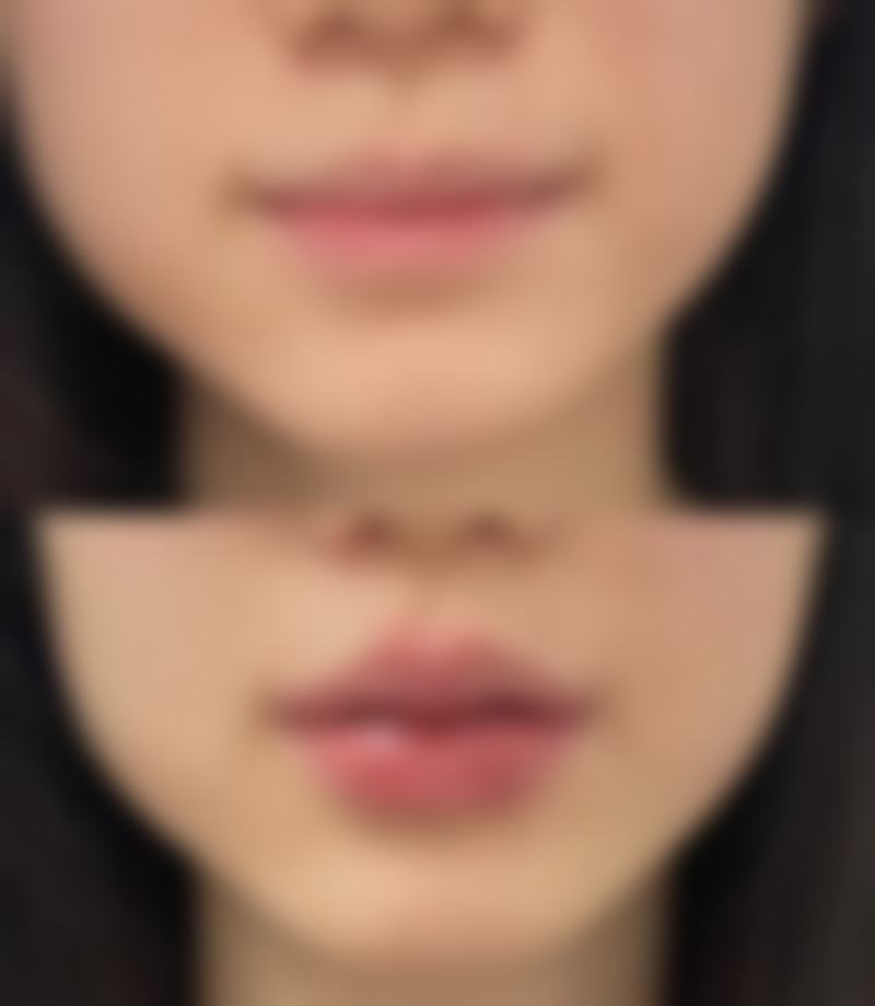 三、面部吸脂后消肿的其他方法