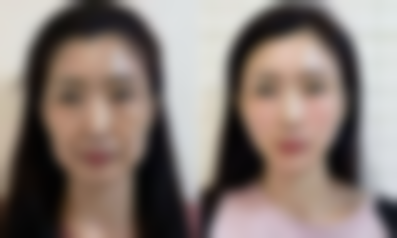 {如何去除眼袋下的脂肪粒？多种方法大揭秘，助你轻松告别眼周小烦恼！ 