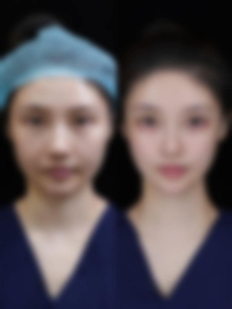 {哪个做切开双眼皮好？从术式选择到医院医生攻略，打造自然好看双眼皮！ 