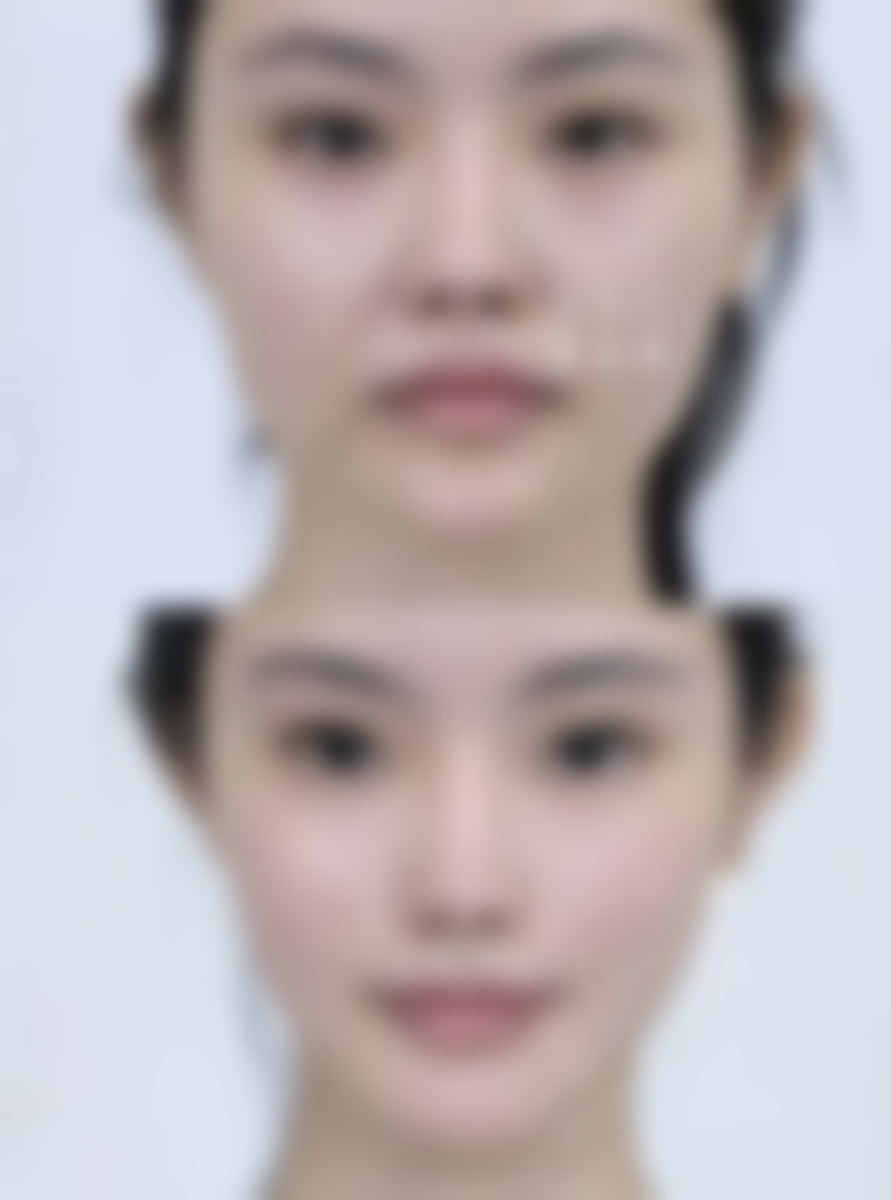 二、toxsta瘦脸针的价格分析