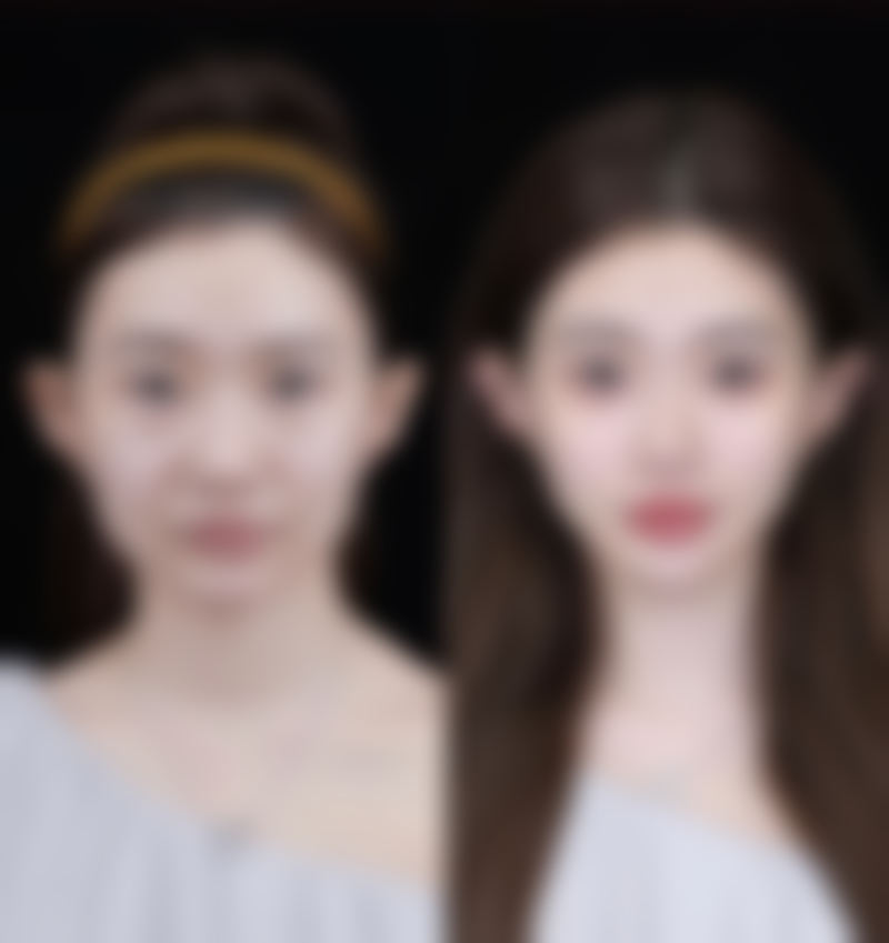 一、隆鼻整形修复期的大致时长