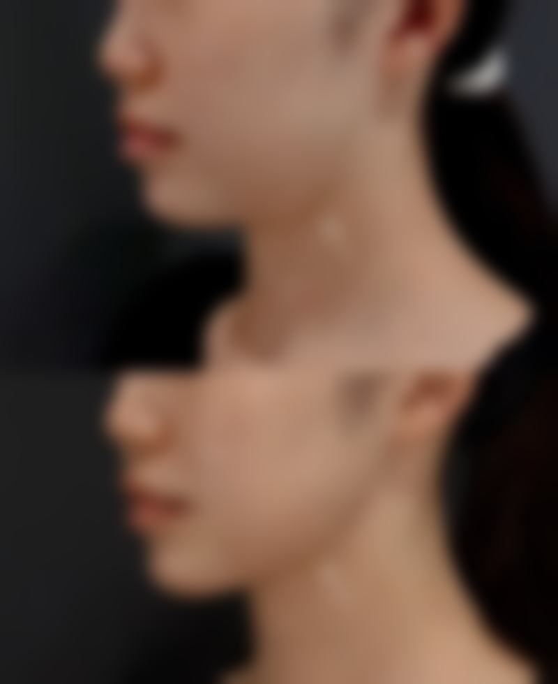 三、隆鼻手术中对山根起点的考量