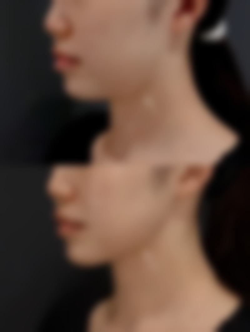 二、瘦脸针成效是否明显因人而异