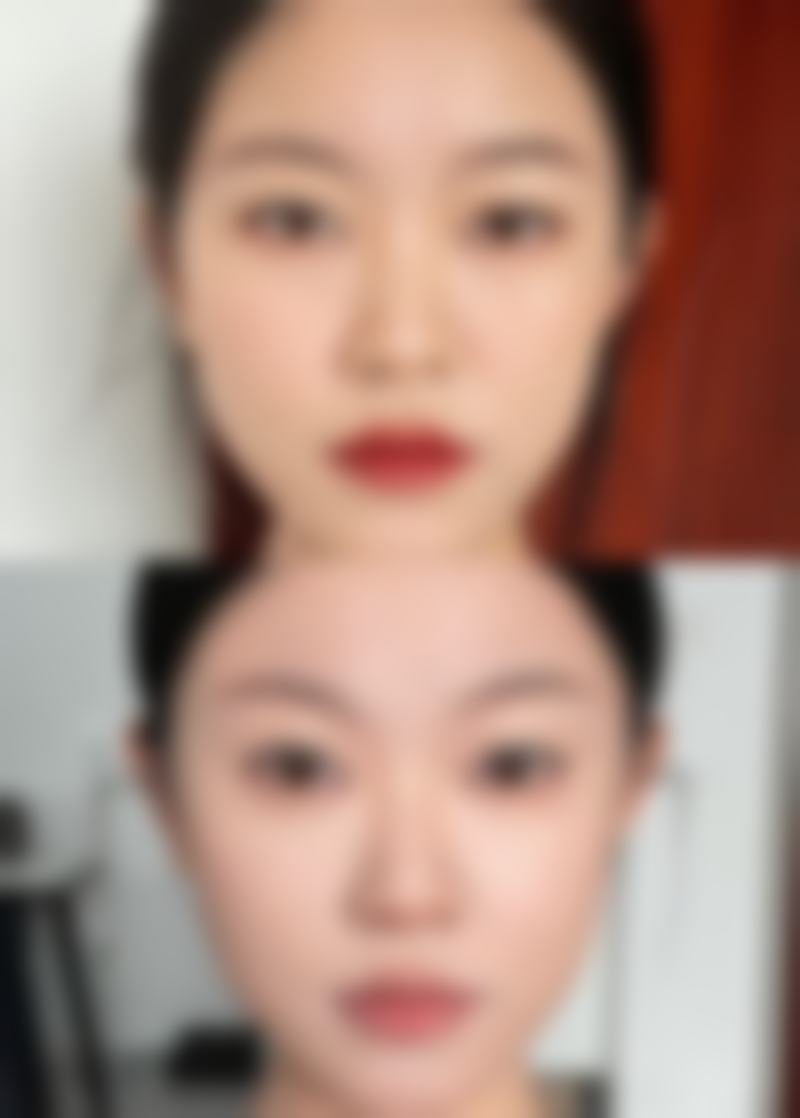 二、肚子吸脂皮会松吗？不同情况大揭秘