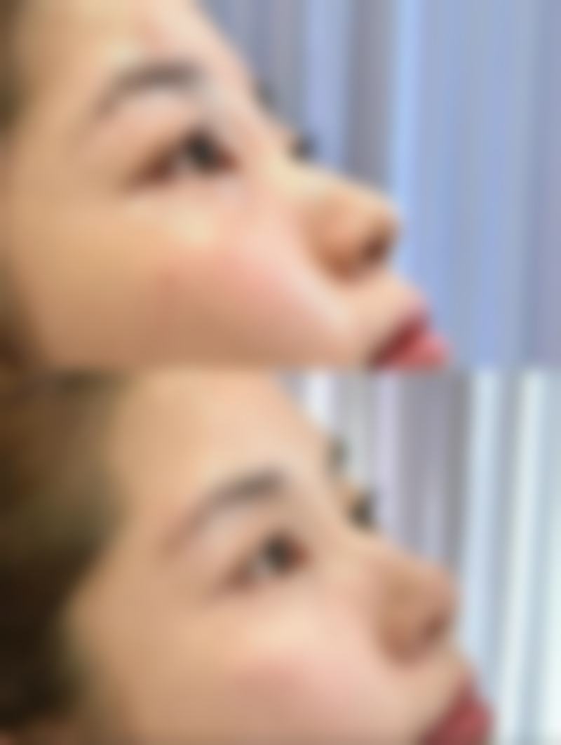 内切眼袋凹陷能长平吗？了解恢复因素与护理方法，助你重获自然美眼