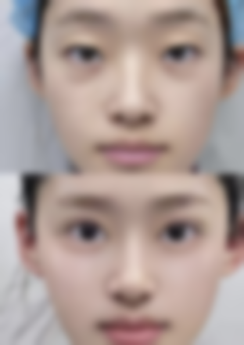 一、天生眼袋黑眼圈的成因分析