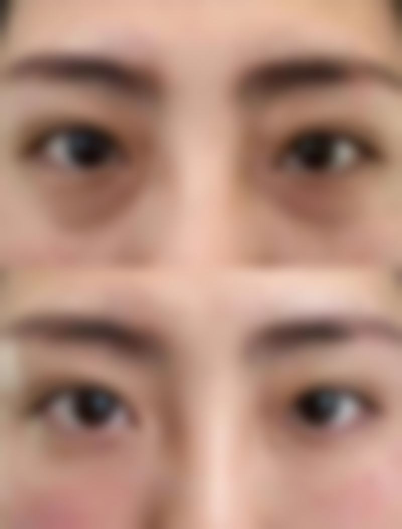 四、影响瘦脸针更终成效的因素