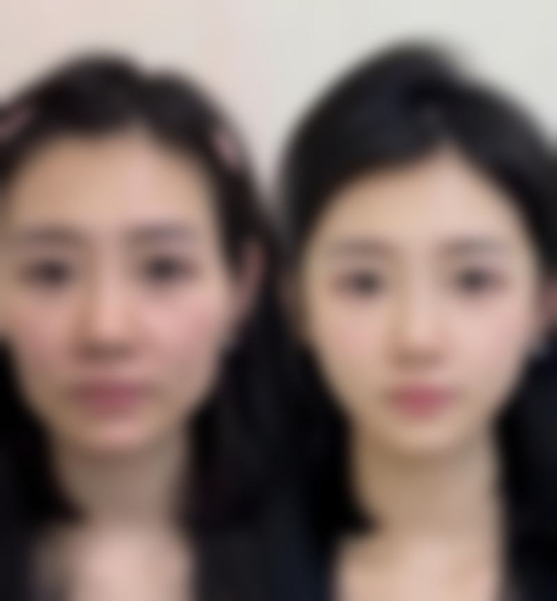 埋线双眼皮什么时候可以拆线？了解恢复时间表，早日拥有自然灵动双眼 