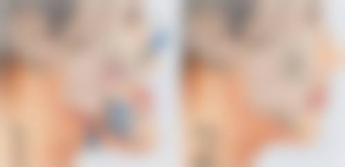 四、耳软骨隆鼻的成效维持时间