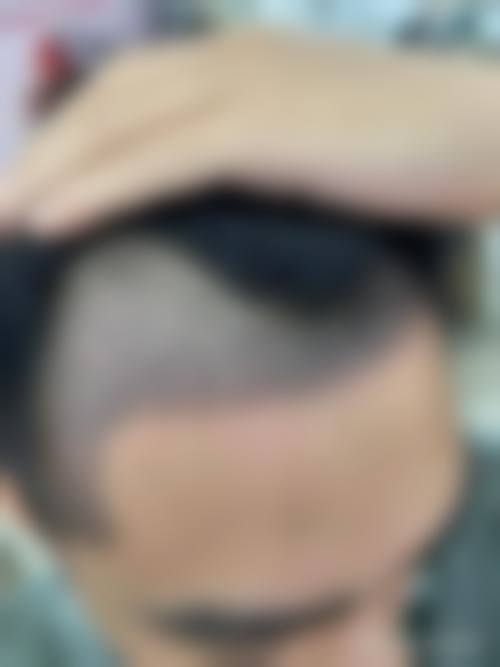 六、韩国毛治植发中 心价格表