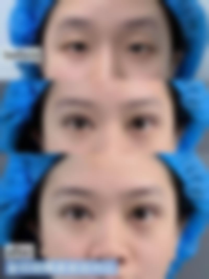 二、耳软骨隆鼻的优势