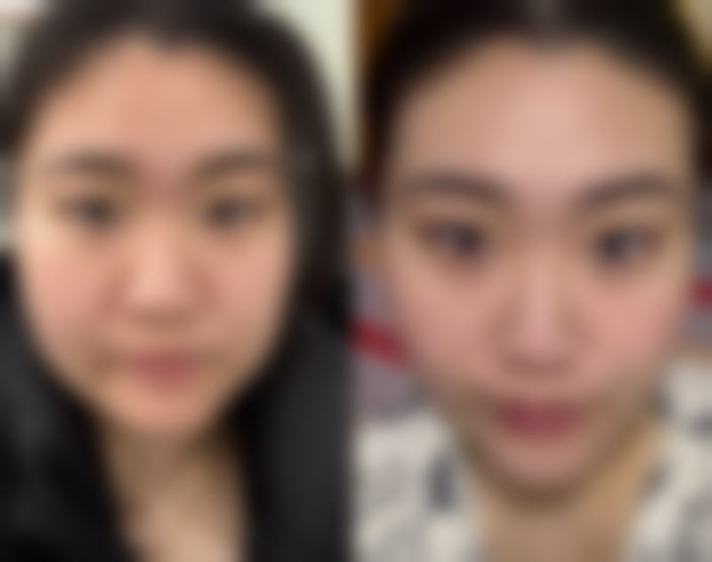 三、怎么去20多年的旧疤痕之特殊情况处理