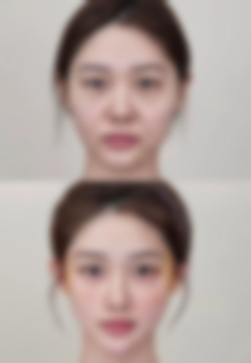 激光去除疤痕的效果好吗？解析不同类型疤痕激光祛疤成效及影响因素 