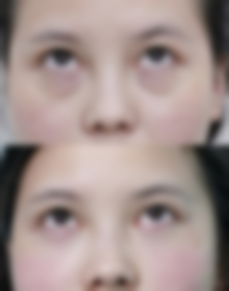 五、怎么快速的消除眼袋之辅助护理与风险提示