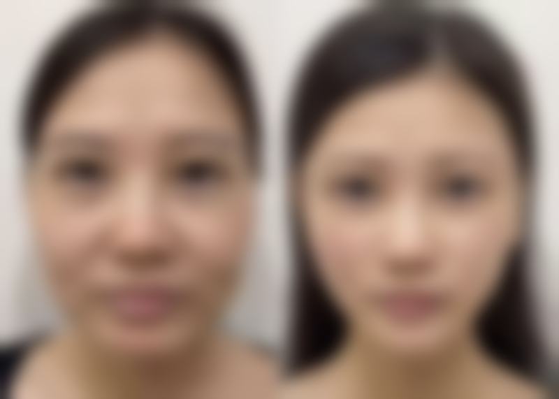 二、眼霜对眼袋和皱纹的作用与局限性