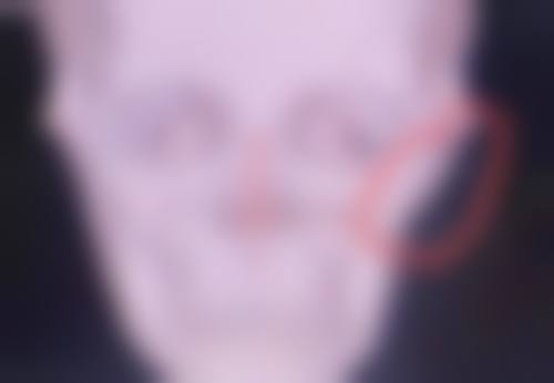 二、疤痕修复的黄金时间