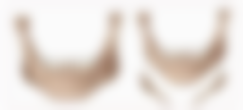 四、线提升隆鼻后期需要取出吗？——适用人群与成效持久性