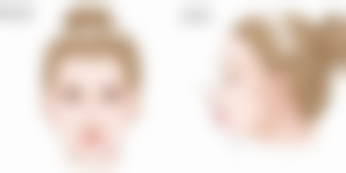 五、埋线双眼皮20天还不消肿需警惕的异常情况