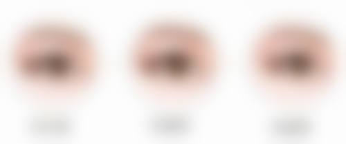 三、线提升隆鼻后期需要取出吗？——不同阶段的注意事项