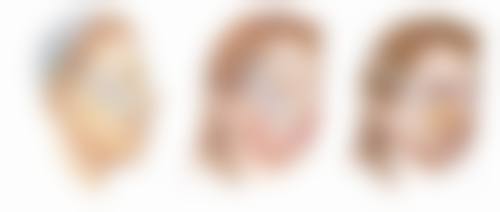 三、割双眼皮后不同修复阶段与种睫毛的关系