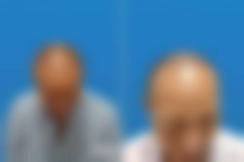 九、广州科发源植发中 心真实的患者评价