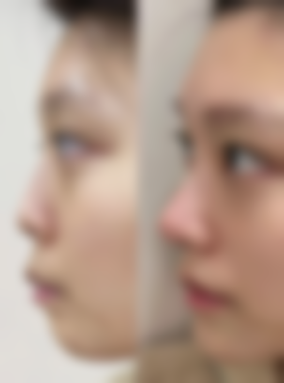 四、双眼皮松单修复的成功几率