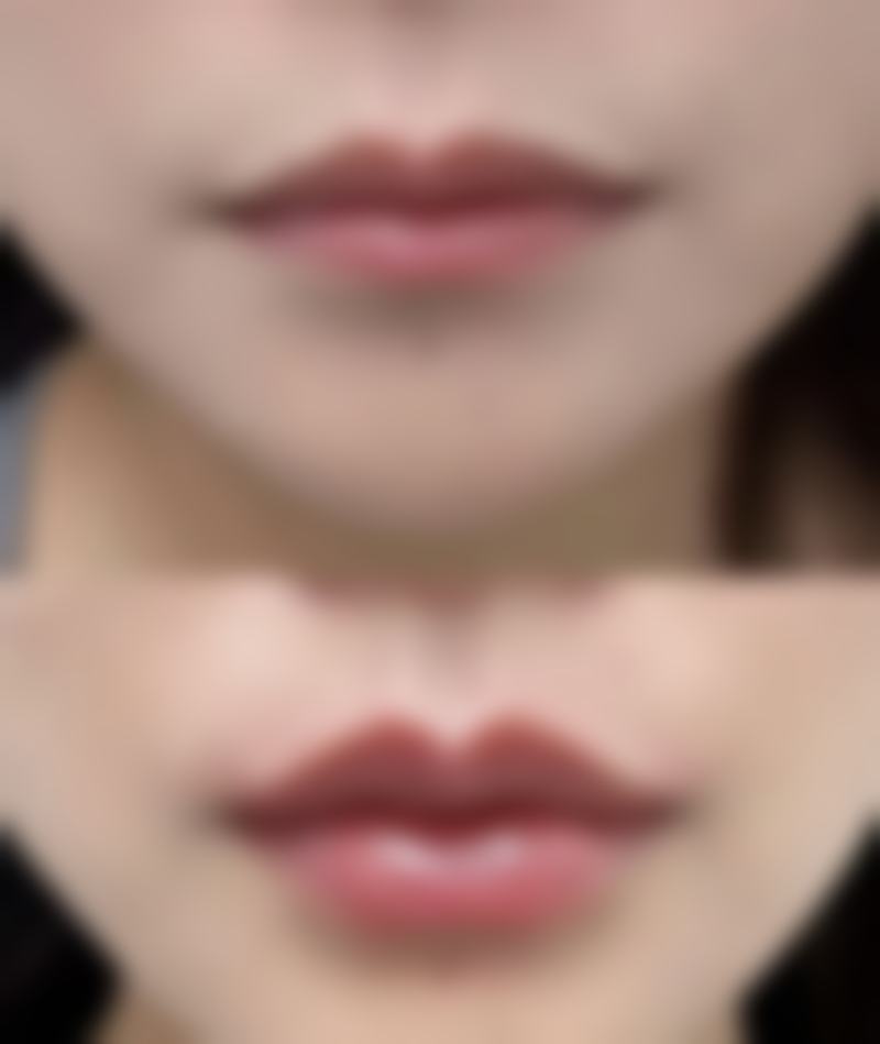 线提升隆鼻后期需要取出吗?