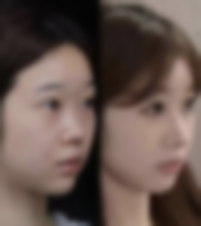 二、埋线双眼皮20天还不消肿的原因分析