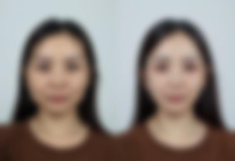 四、去除眼袋黑眼圈的注意事项