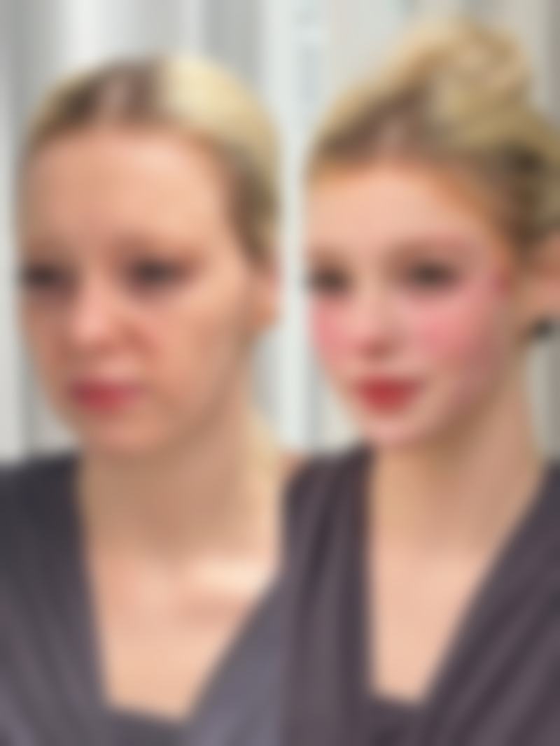 三、一次除皱针维持时间的典型范围