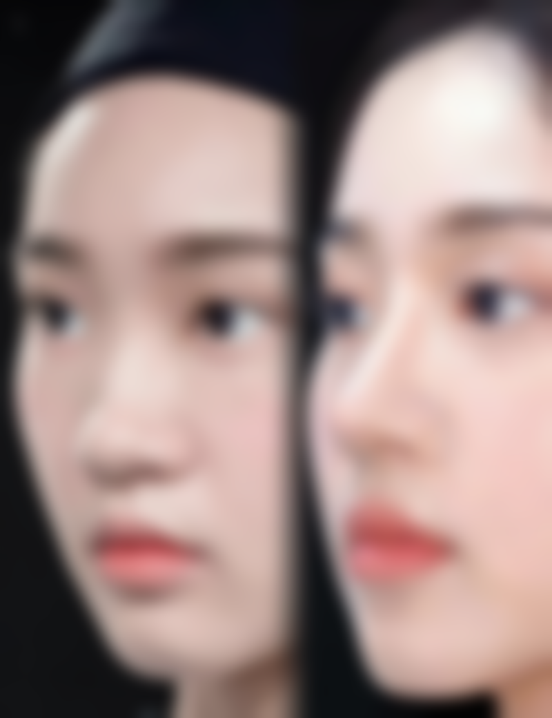 一、线提升隆鼻后期需要取出吗？——可吸收线特性揭秘