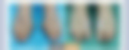 双眼皮拆线后多久伤口愈合？了解愈合时间，掌握拆线后几天可沾水要点