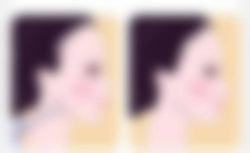 七、美学成效对比:从外观决定假体隆胸和自体隆胸哪个成效好