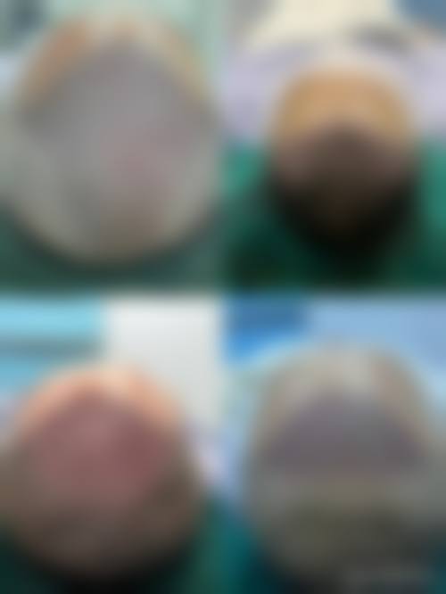 三、呼和浩特沐森植发医院诊疗项目有哪些?