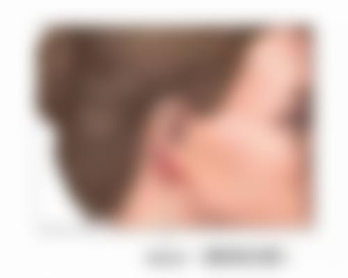 三、平行双眼皮手术的关键影响因素