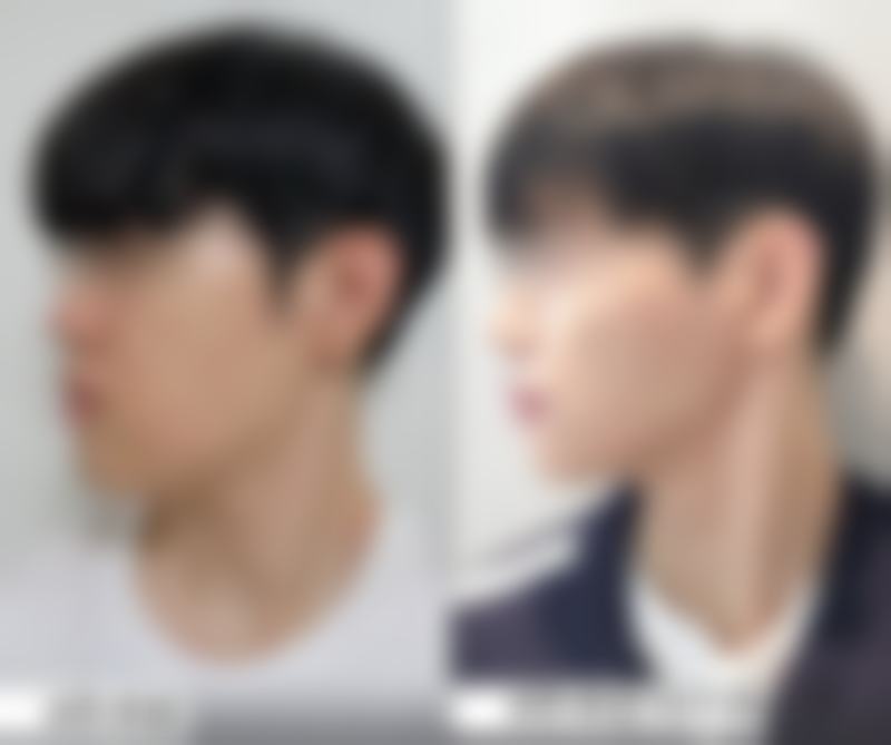 什么叫平行双眼皮及平行双眼皮手术：特点、适合人群与方案全解析！ 